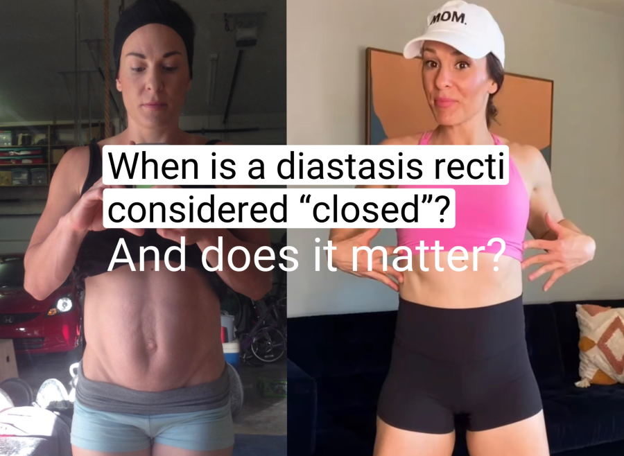 when is diastasis recti considered closed and does it matter