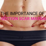 importance of c section scar massage