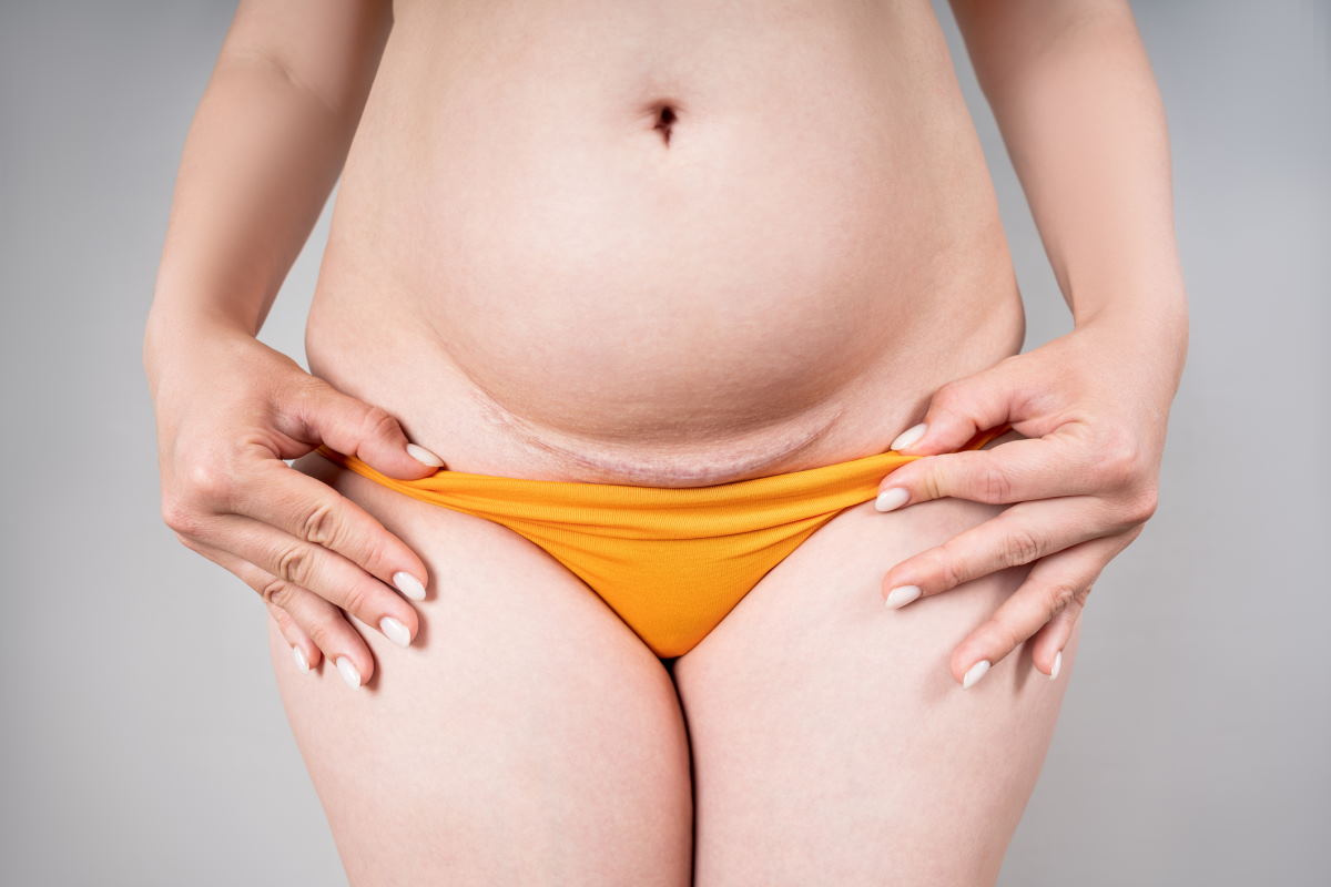 Caesarean section recovery: Tips and Advice - Whole Body Health & Wellness