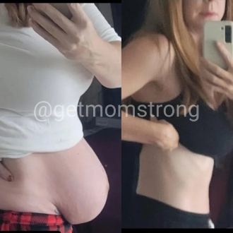 Diastasis Recti Before and After | Get Mom Strong